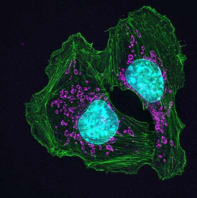Клетки рака кожи. Фото: NIH Image Gallery / Flickr.com