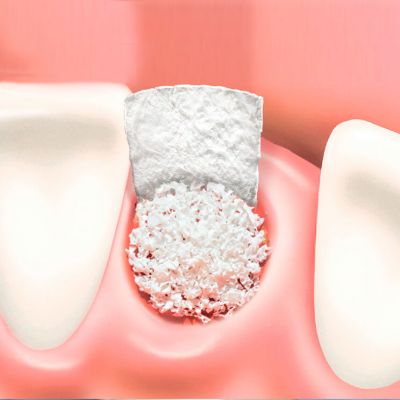 Особенности проведения остеопластики при установлении зубных имплантов