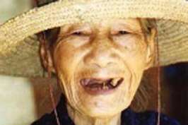 Потеря зубов в старости связана с повышенным риском слабоумия