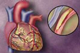 Обнаружена связь между болезнями сердца и раком кишечника