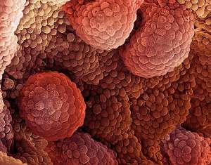 Рак предстательной железы; сферические гроздья-скопления — колонии раковых клеток. (Фото Steve Gschmeissner.)