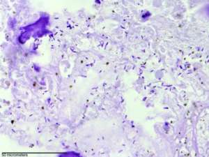 Бактерии Clostridium novyi в злокачественной опухоли собаки (фото David L. Huso, Baktiar Karim/Johns Hopkins Department of Pathology).