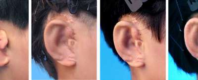 Китайские исследователи пересадили детям с микротией ушные раковины, созданные с помощью 3D-печати на основе собственных клеток пациентов.