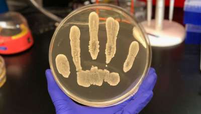 Найден штамм кожной бактерии, который эффективно уничтожает раковые клетки. Фото UC San Diego Health.