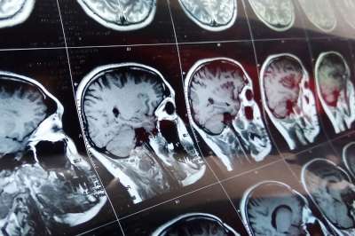 Болезнь Альцгеймера, деменция и даже глубокий паралич не будут для человека приговором, если подтвердятся ожидания от экспериментальных исследований компании Neuralink, основанной в 2016 году Илоном Маском. Фото: iStock 