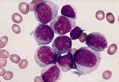 Клетки острого миелоидного лейкоза. Фото: Wikipedia