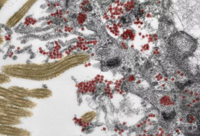 Реснитчатые ​​клетки обонятельной слизистой оболочки, инфицированные вирусом SARS-CoV-2 (красный), под электронным микроскопом. Фото: Michael Laue/RKI & Carsten Dittmayer/Charité