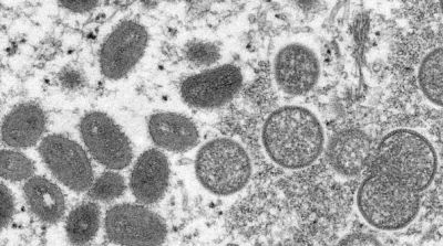 Образец кожи человека с вирусом оспы обезьян под микроскопом. Архивное фото AP Photo.