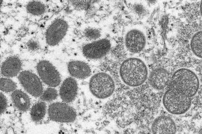 Образец кожи человека с вирусом оспы обезьян под микроскопом. Фото: AP Photo.