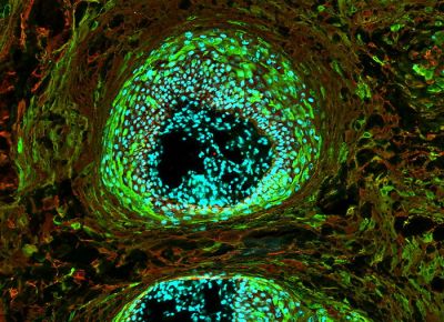 Клетки плоскоклеточной карциномы. Фото: NIH Image Gallery / Flickr.com.