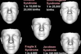 3D-изображения лица позволяют выявить редкие генетические заболевания