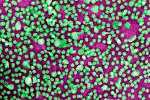 Липопротеины низкой плотности (ЛПНП), одна из основных форм транспорта липидов в организме, при высоком содержании в плазме крови могут служить причиной развития атеросклероза. (Фото Science Photo Library.)