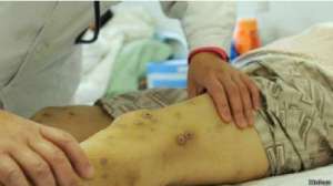 В местных больницах до сих пор лечатся люди, пострадавшие летом от укусов шершней. Фото: BBC 