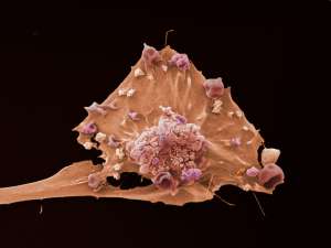 Клетка рака молочной железы. (Фото Visuals Unlimited / Corbis.)
