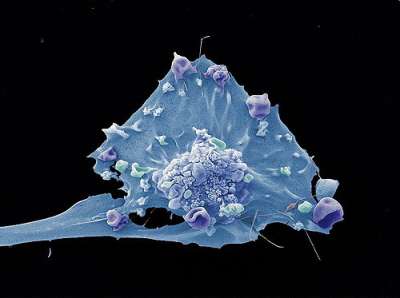 Клетка рака молочной железы. (Фото: Medico Space / Flickr.com.)