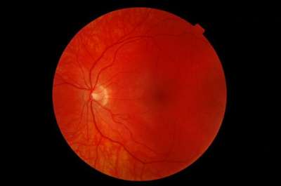 Кровеносные сосуды глазного дна могут сообщить о начинающихся проблемах с кровоснабжением в мозге.